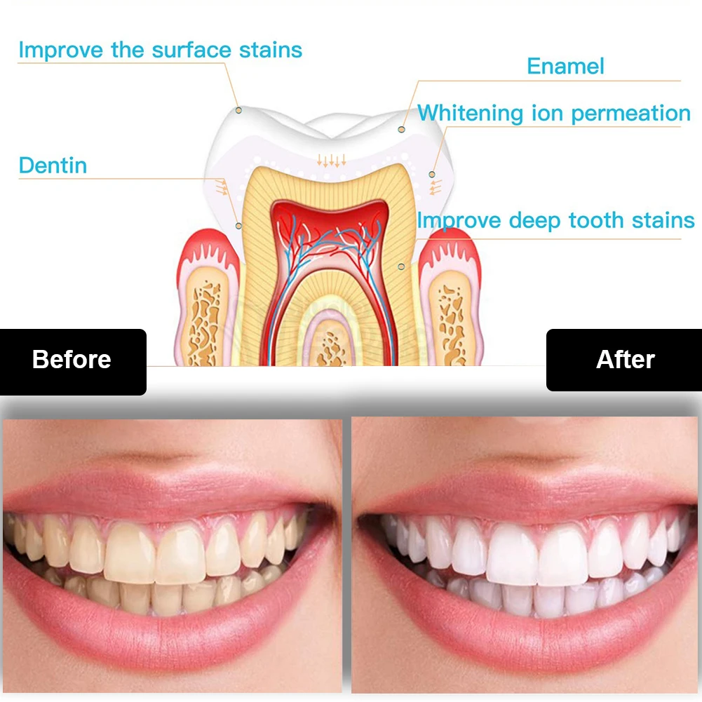 Dental Teeth Whitening Kit Min - Teeth Whitening Near Me review and price